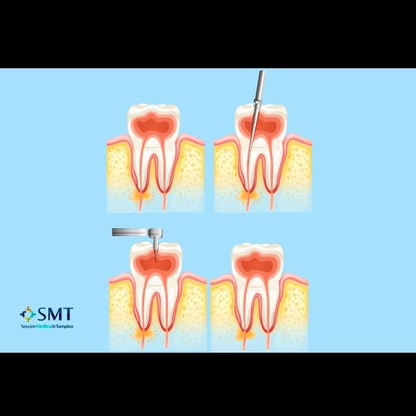 Endodoncistas en Tampico